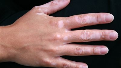 جربي هذه الأطعمة لعلاج مرض البهاق