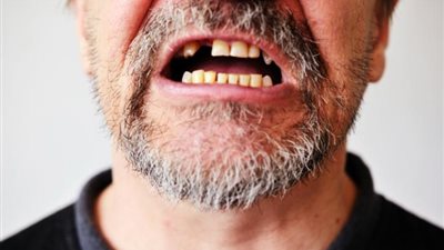 احذر.. سقوط 5 أسنان مؤشر على الموت المبكر