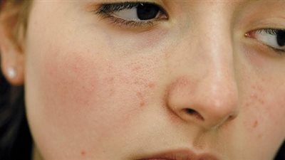 إليك هذه الخلطة المنزلية للتخلص من حب الشباب نهائياً ! 