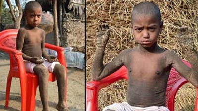 بسبب مرض نادر.. يتحول هذا الطفل لـ 