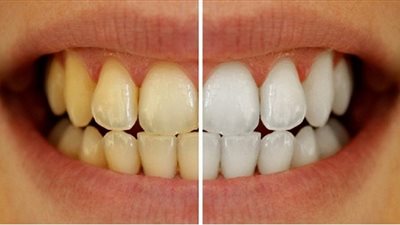 هذه الوصفة تبيض وتزيل تكلس أسنانكم من الإستعمال الأول! 