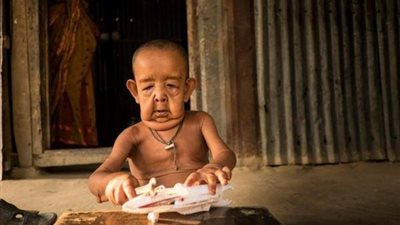 عندما يشيخ الأطفال.. عمره 4 سنوات ومصاب بمرض الشيخوخة المبكرة (صور)