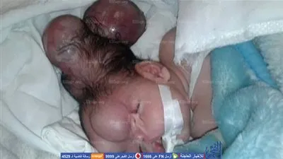 قبل سفرها للسعودية.. الطفلة أسماء تجري أشعة رنين بمستشفى كفر الشيخ  