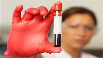 تحليل الدم قد يساعد على اكتشاف سرطان المبيض مبكرا