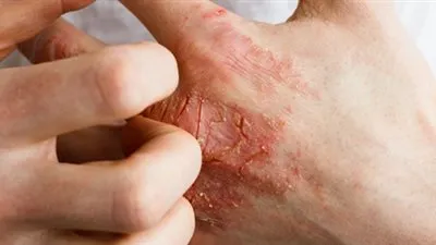 نصائح صحية للوقاية من الاندفاعات الجلدية على اليدين !