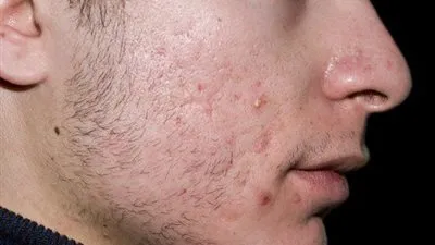 خلصوا من آثار حب الشباب بهذه الوصفة الطبيعية