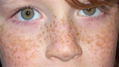 أسرع وصفة للتخلص من نمش الوجه (فيديو)