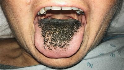 حالة غريبة.. شعر ينمو على 