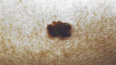 طريقة جديدة لمكافحة أخطر أنواع السرطان