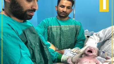 أغرب قصة حمل.. طفلة بعمر يومين حامل في جنين مكتمل النمو (فيديو)