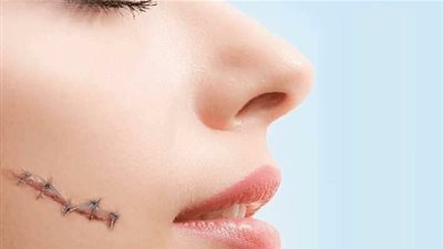 أسباب بقاء آثار الجروح القديمة وطرق التخلص منها 