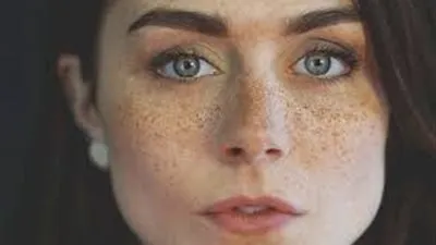 طرق ذهبية للقضاء على النمش نهائيا (فيديو)