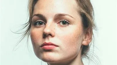 نصائح مذهلة للتخلص من الكلف