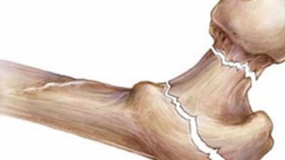 في يومه العالمي.. كيف تحمي عظامك من الهشاشة؟