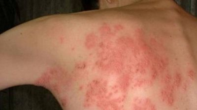 من أسبابه ضعف جهاز المناعة.. حقائق حول مرض الحزام الناري