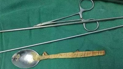استخراج ملعقة من بطن شاب ابتلعها بالخطأ لمدة عام!
