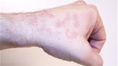 دراسة.. الرجال أكثر عرضة لـ