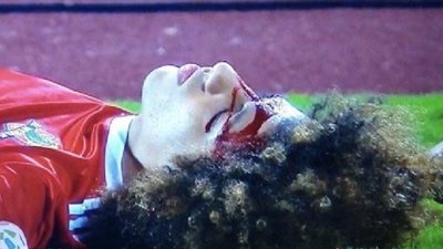 علي النمر يكشف عن إصابته.. 5 كسور تحت العين وبالأسنان