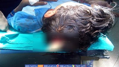 الأقصر الدولي تنقذ طفل نفذ جسم خشبي في مخه  (صور) 