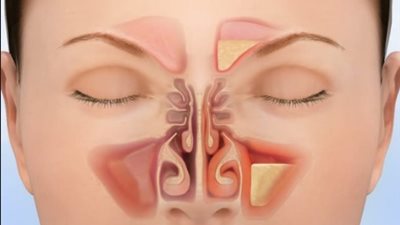 مع تقلبات الجو.. روشتة صحية لمرضى الجيوب الأنفية