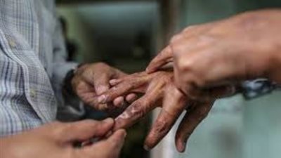 حكايات اليوم.. انتهاء الحرب الفرنسية البروسية..واليوم العالمي للجذام