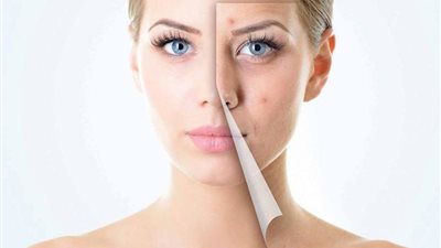 تخلصي من آثار حب الشباب والجروح على الجلد بهذه النصائح 