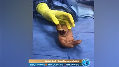 مستشفيات جامعة المنوفية تنجح في توصيل إصبع باليد اليمنى بعد بتره