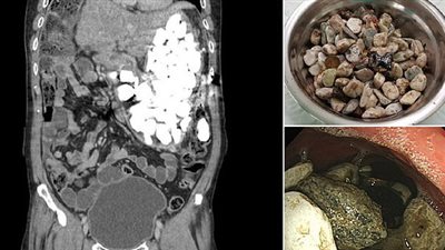 استخراج حجارة ونقود تزن 2 كجم من معدة رجل