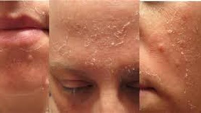 تقشير الجسم بالليزر.. التفاصيل الكاملة والخطوات