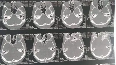 استئصال ورم دموي من جمجمة طفل 9 سنوات بتأمين بنها النموذجي (صور)