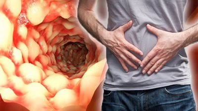 أطباء يحذرون من انتشار مرض خطير في مصر .. تعرف على الأعراض