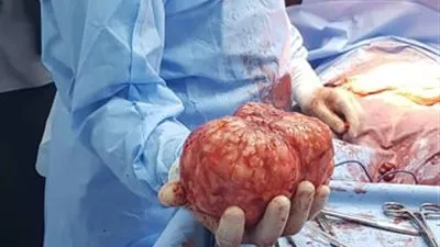استئصال ورم ليفي من بطن فتاة يزن 3 كليوجرامات في قنا