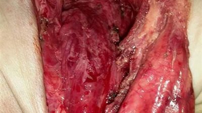 استئصال جزئي لورم نادر 4 كيلو جرام من جسد طفلة حديثة الولادة بتأمين بنها (صور)