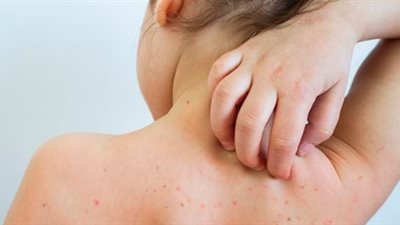 اكتشاف 704 إصابة جديدة فى 22 ولاية أمريكية