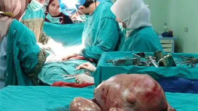 استئصال ورم 20 كيلو من رحم سيدة بـ