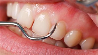 دراسة تربط بين أمراض اللثة وسرطان الكبد
