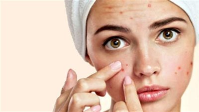 حلول مذهلة للقضاءعلى حب الشباب نهائيا