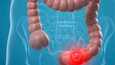 استشاري جهاز هضمي يقدم روشتة سحرية للوقاية من سرطان القولون 