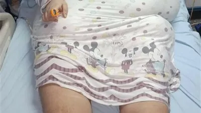 مستشفى جامعة المنصورة تجرى جراحة تكميم لإنقاذ مريضة وزنها ٣٠٠ كجم 