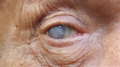 تعرف على أسباب الإصابة بمرض 