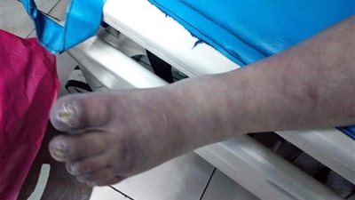 تعرف على الحالة الصحية للطفلة المعذبة على يد جدتها بالدقهلية