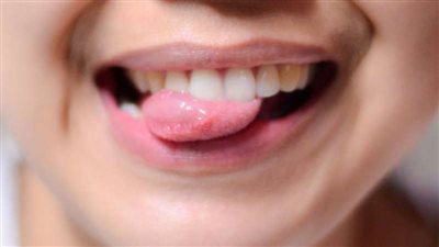 رفضت إعطاءه نقودًا.. رجل قطع لسان زوجته أثناء محاولته تقبيلها