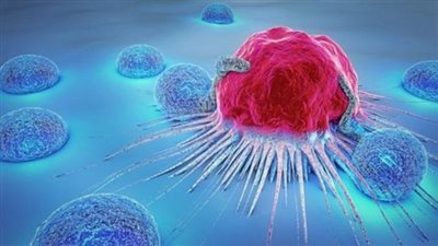 عميد القومي للأورام: تحسن طرق الكشف عن السرطان زاد من اكتشاف الحالات