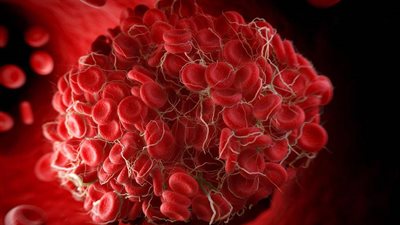 للرجال.. تعرف على الأغذية التي تقي من تجلط الدم