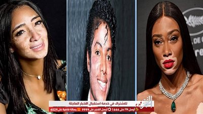 آخرهم رامي جمال.. مشاهير أصيبوا بمرض البهاق منهم مايكل جاكسون (صور)