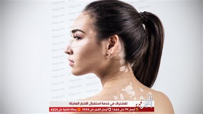 بعد أن أصاب رامي جمال.. أسباب مرض البهاق وطرق العلاج منه 