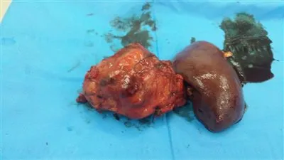 استئصال ورم يزن ٦ كيلو من سيدة بمركز أورام طنطا (صور)