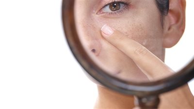 أسهل طريقة لشد مسام البشرة الدهنية في وقت قياسي