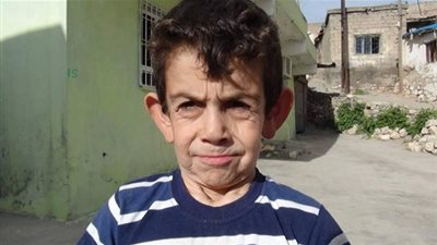 الشيخوخة المبكرة مرض يهدد الأطفال.. تعريفها وأسبابها ومراحل الشفاء منها