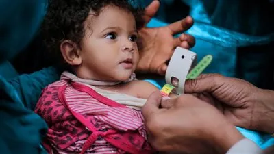 ماليزيا تعلن عن أول إصابة بشلل الأطفال منذ 1992